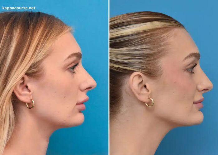 How Rhinoplasty Helps Correct Deviated Septums and Other Nasal Issues